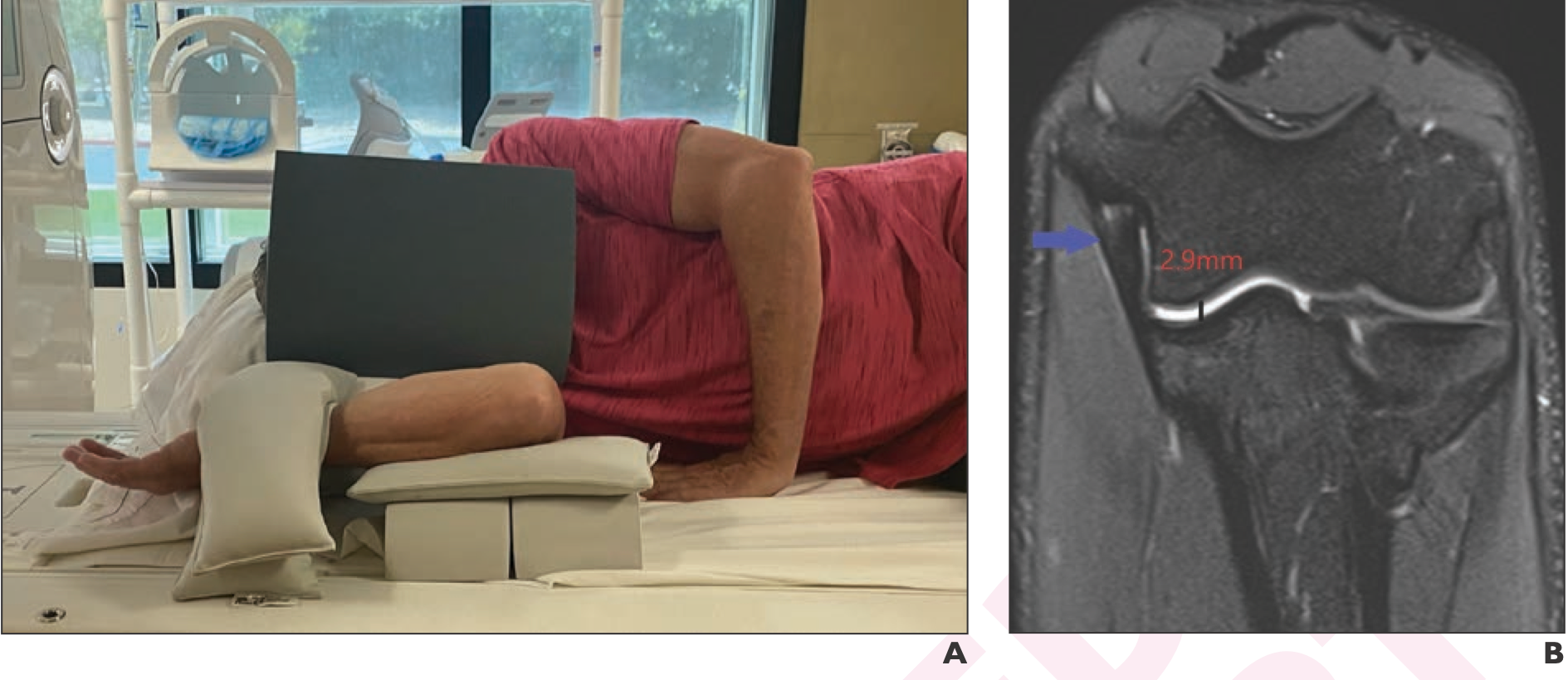 (a) Side view of a volunteer demonstrating proper positioning for the flexed elbow valgus external rotation (FEVER) view; note the elevated flexed elbow and sandbags to induce valgus stress. The elbow coil is not included in the image. (b) Coronal fat-saturated proton-density weighted MR image in FEVER view in 20-year-old male pitcher shows a normal anterior bundle of the ulnar collateral ligament (blue arrow) and 2.9 mm ulnotrochlear articular width. (c) Sagittal scout view shows flexed elbow position; lines depict the approximately 35° scan angle for the FEVER view.

Credit: American Journal of Roentgenology