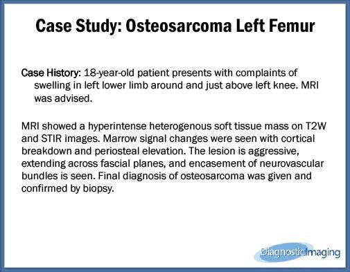 Osteosarcoma Left Femur
