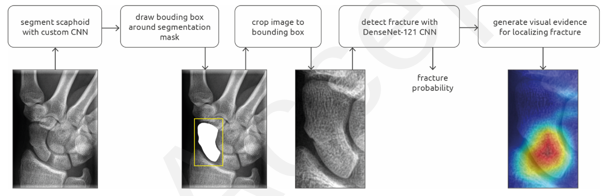 Overview of the scaphoid fracture detection pipeline, which consisted of a segmentation and detection convolutional neural network (CNN). A class activation map is calculated and visualized as a heatmap for fracture localization.



Credit: RSNA

