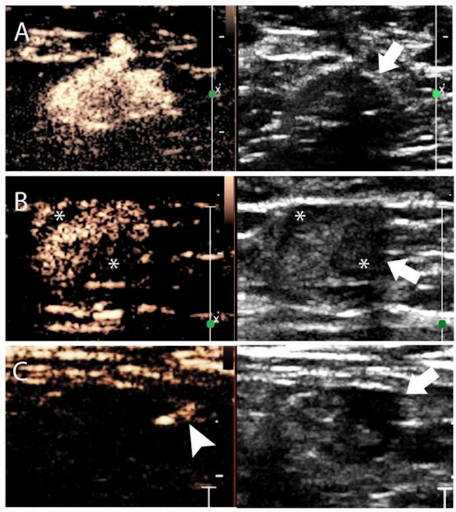 Ultrasound Nomogram May Enhance Prediction of Metastatic Axillary Lymph Nodes in Breast Cancer Patients
