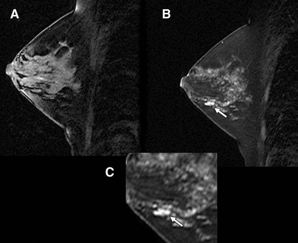 Breast MRI Use Increased, But Not Always Appropriately