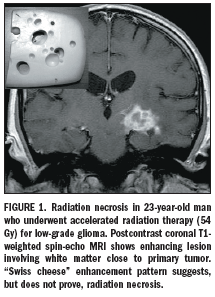 MRS, perfusion MRI separate radiation necrosis from tumor