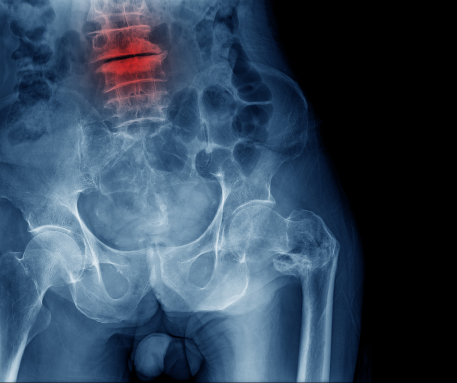Should Vertebral Fracture Assessment be Standard Prior to ADT Treatment for Prostate Cancer?