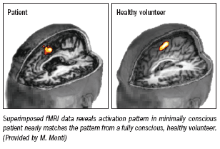 fMRI indicates cognition in unconscious patients