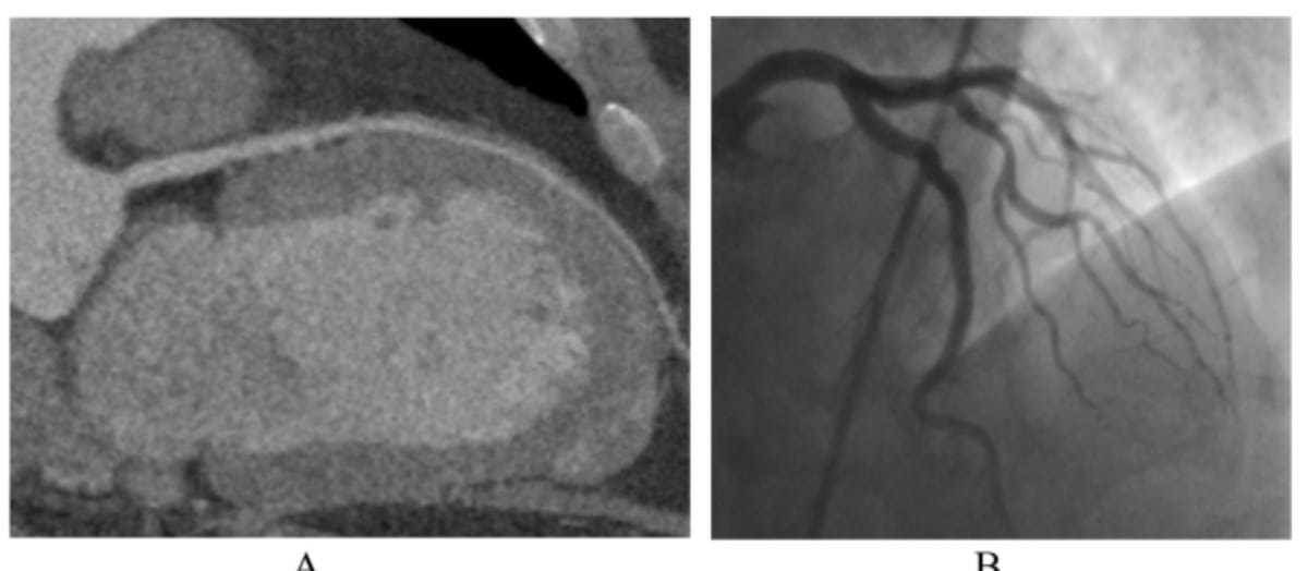 Study Offers Closer Look at Patient Preferences for CT Angiography Over Invasive Coronary Angiography