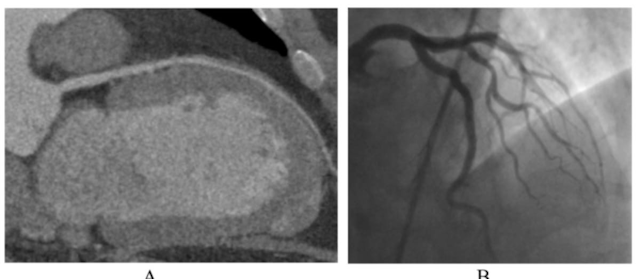 Study Offers Closer Look at Patient Preferences for CT Angiography Over Invasive Coronary Angiography