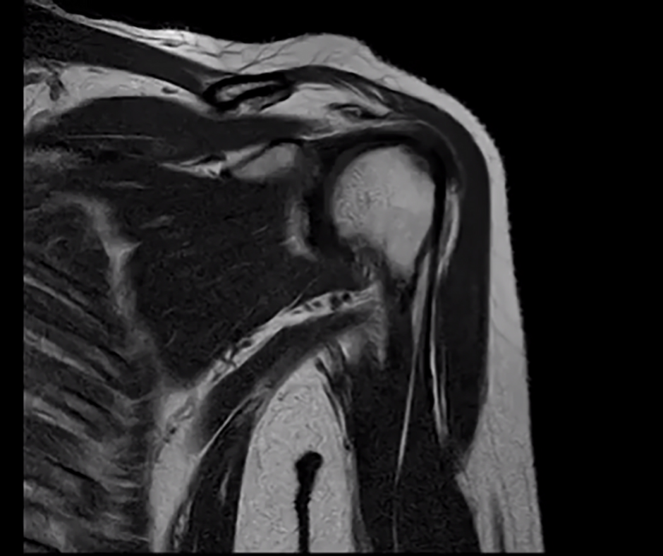 Could an AI-Powered Enhancement of MRI be a Pre-Op Game Changer for Total Shoulder Arthroplasty?