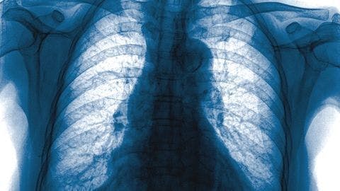 Chest X-ray and Chest CT Critical to Early Diagnosis of TB 