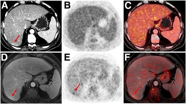 PET/MRI Outperforms PET/CT in Cancer Imaging