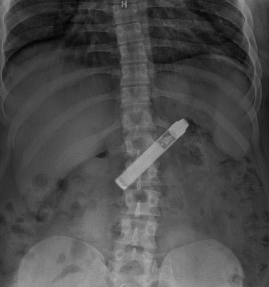 Image IQ Quiz: What Did This Patient Swallow?