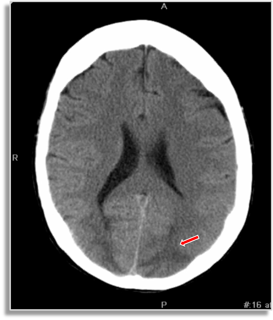 Image IQ Quiz: 38-Year-Old Female with Hypertension and Visual Disturbance