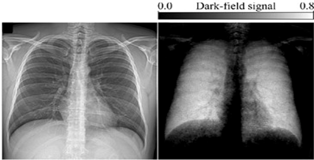 X-ray Dark-Field Imaging Shows Potential for Diagnostic Assessment of Lungs