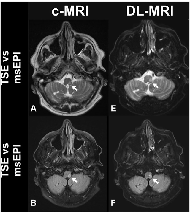 Can Deep Learning MRI Have an Impact In Suspected Stroke Cases?