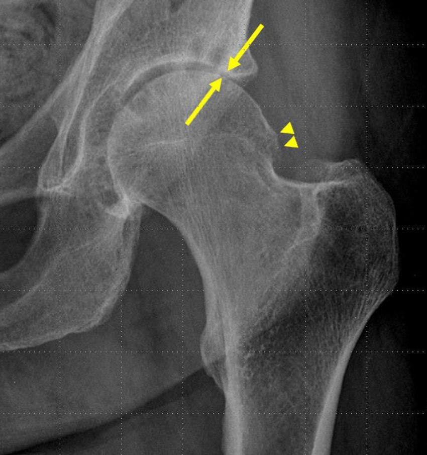 Hip Injections for Osteoarthritis May Speed Up Osteonecrosis