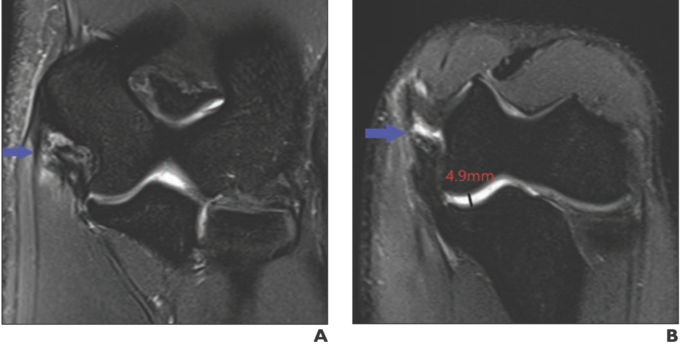 Standard (a) and flexed elbow valgus external rotation (FEVER) (b) coronal MR images in 23-year-old male pitcher with acute medial elbow pain. High signal distortion, retraction, and periligamentous edema of the prox- imal ulnar collateral ligament (UCL) indicate high grade partial tear on standard view (blue arrow). On FEVER view, the proximal UCL shows a rela- tively more localized high signal tear (blue arrow), less retraction, and less periligamentous edema with moder- ate ulnotrochlear joint space widening (4.9 mm).

Credit: American Journal of Roentgenology