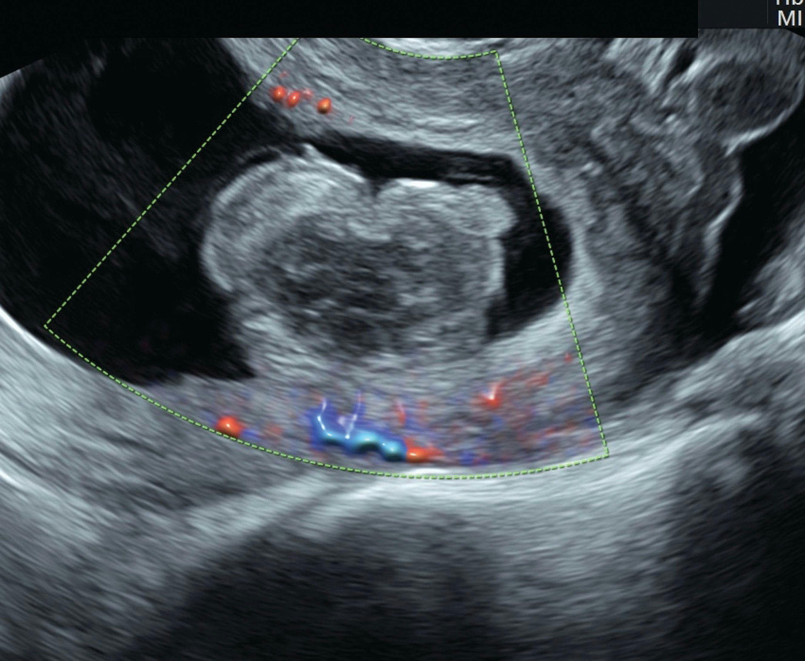 Ultrasound is a Critical Tool of Managing Miscarriage