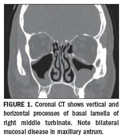 CT and MRI show complexparanasal sinus anatomy