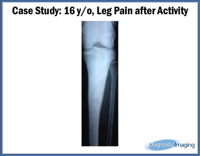 16 y/o, Leg Pain after Activity