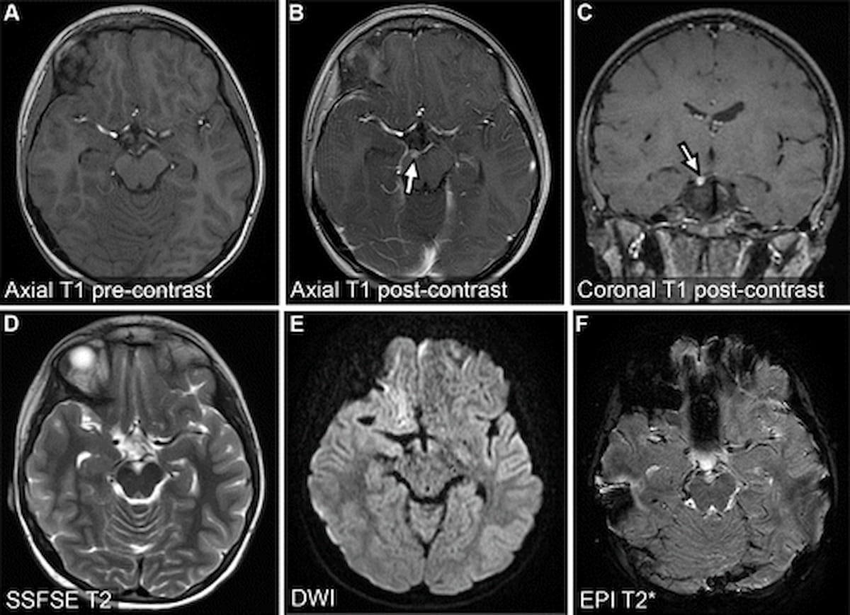 Can Abbreviated MRI Have an Impact in Neuroimaging?