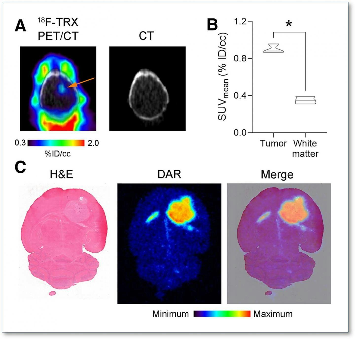 New Radiotracer Identifies Iron Levels in Tumors