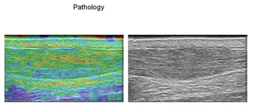 Elastography breaks new ground in musculoskeletal imaging