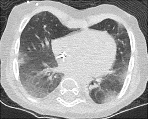 Figure 5- A 21-month-old female with Hurler’s disease status post bone marrow transplant and positive COVID-19 RT-PCR test who presented with fever and respiratory distress. Axial lung window CT image shows bilateral peripheral and subpleural ground-glass opacities, which are typical CT findings in pediatric COVID-19. Courtesy: Radiology: Cardiothoracic Imaging