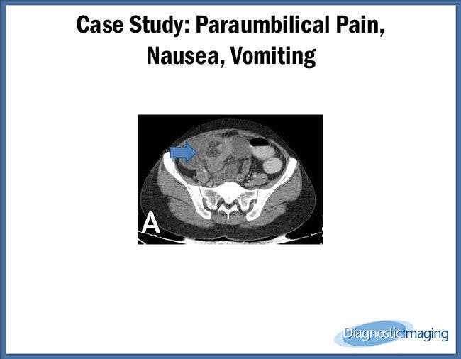 Paraumbilical Pain,  Nausea, Vomiting
