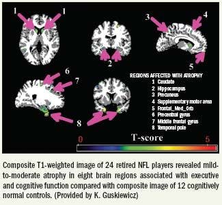 MRI reveals brain damage in retired athletes