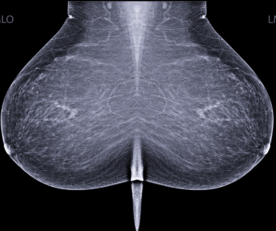 What a New Meta-Analysis Reveals About Breast Density, Mammography and MRI Screening