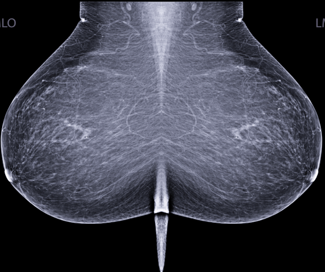 What a New Review Reveals About Mammography-Based AI and Breast Cancer Risk Assessment