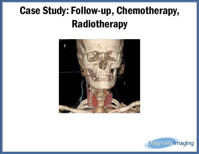 Follow-up, Chemotherapy, Radiotherapy