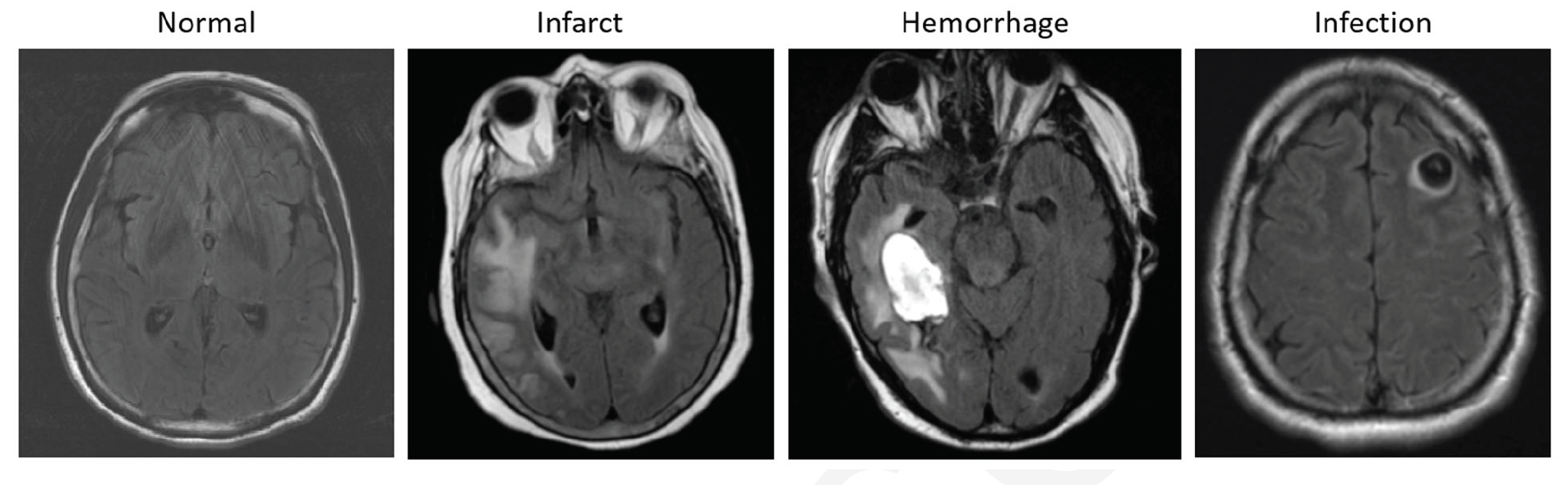 Examples of axial FLAIR sequences from studies within dataset A. From left

to right: a patient with a ‘likely normal’ brain; a patient presenting an intraparenchymal

hemorrhage within the right temporal lobe; a patient presenting an acute infarct of the

inferior division of the right middle cerebral artery; and a patient with known

neurocysticercosis presenting a rounded cystic lesion in the left middle frontal gyrus.

Credit: RSNA