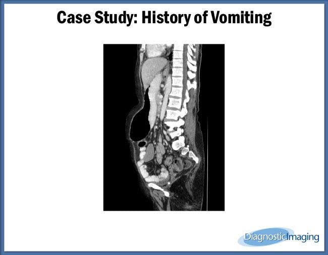 History of Vomiting