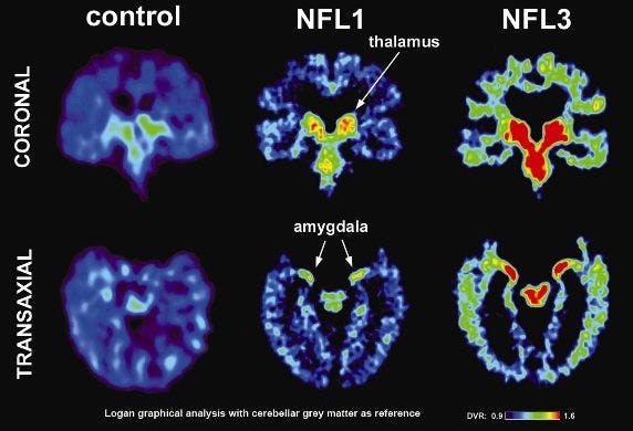 FDDNP-PET Shows Brain Injury in Former NFL Players