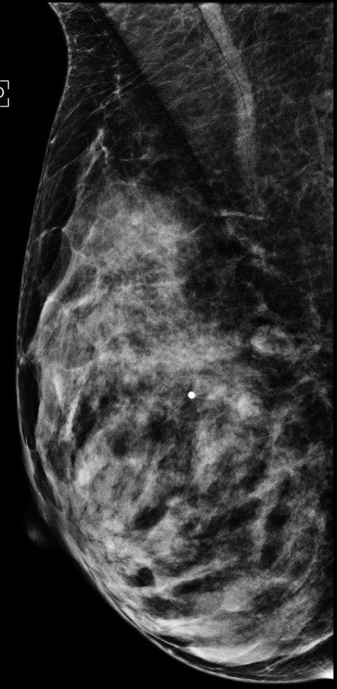 Image IQ: Palpable Lesion in a Prior Cancer Patient