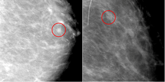 Cancer Recurrence in Autologous Reconstructed Breast