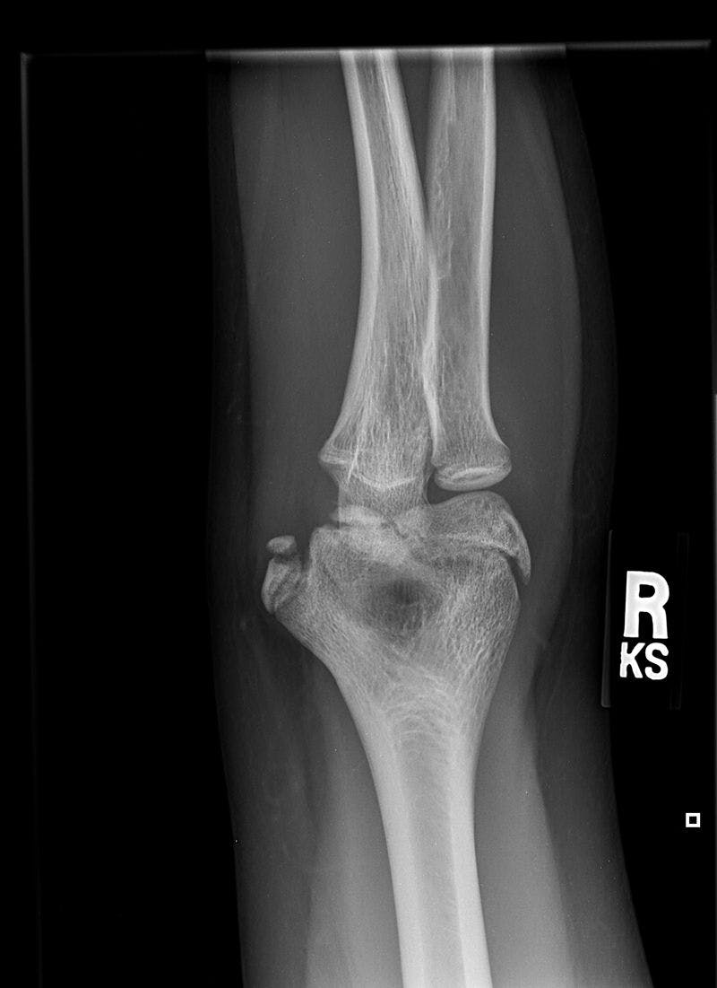 Image IQ: 12-year-old Boy With Acute Medial Elbow Pain