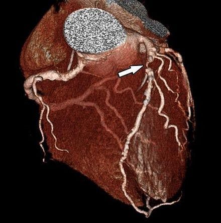 Can Cardiac CT be a Viable Alternative for Diagnosing Coronary Artery Disease?