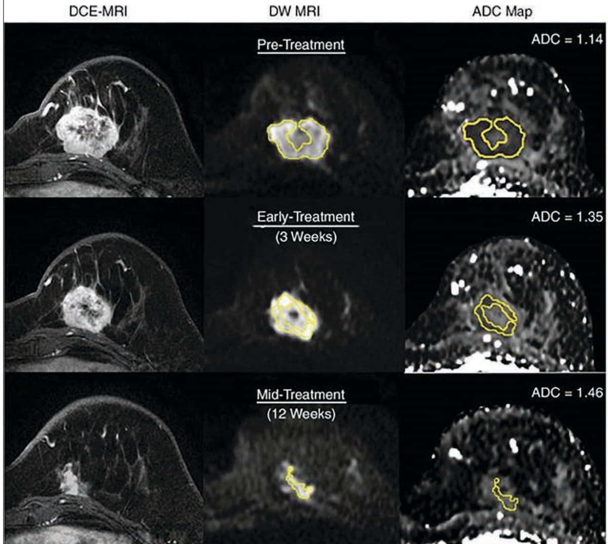 Can DWI MRI Offer a Viable Non-Contrast Alternative for Breast Cancer Assessment?