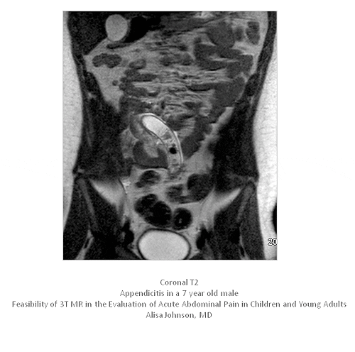 Three-T MRI triages kids with acute abdominal pain