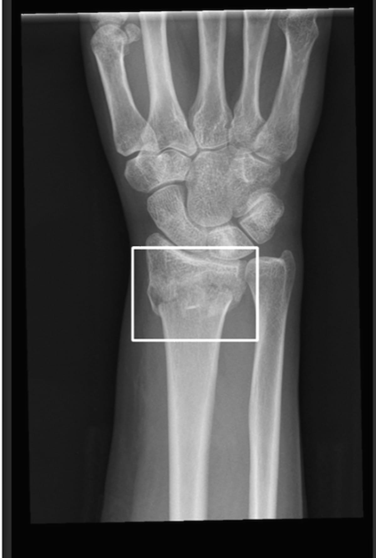 AI Facilitates Nearly 83 Percent Improvement in Turnaround Time for Fracture X-Rays