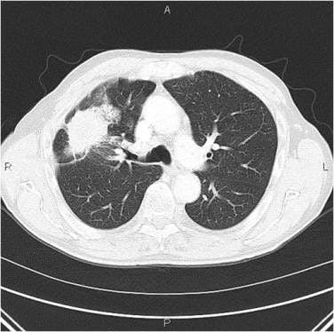 Adenocarcinoma of the Lung