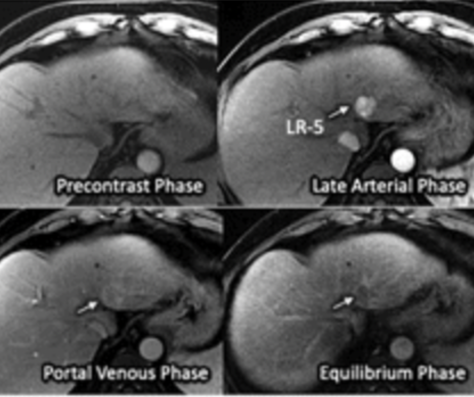 Abbreviated MRI and Early-Stage Hepatocellular Carcinoma: What a New Multicenter Study Reveals