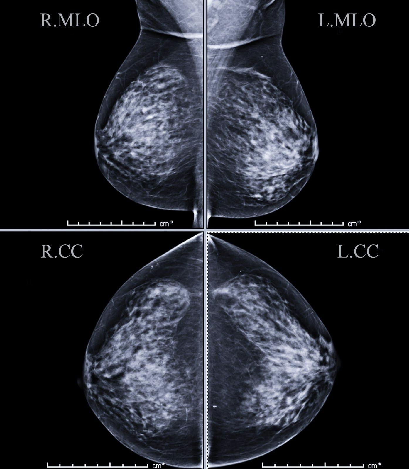Zebra Medical Vision Captures 1st FDA Clearance for Oncology with Mammography Solution