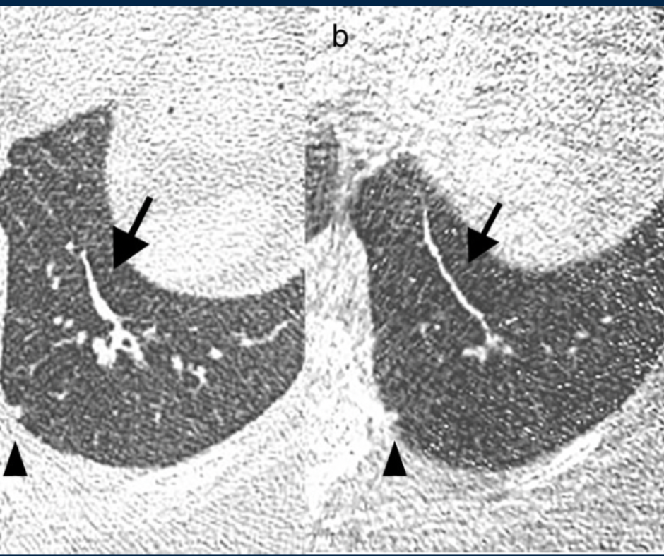 Can Ultra-Low-Dose CT be Effective for Lung Cancer Screening in Current or Past Smokers?