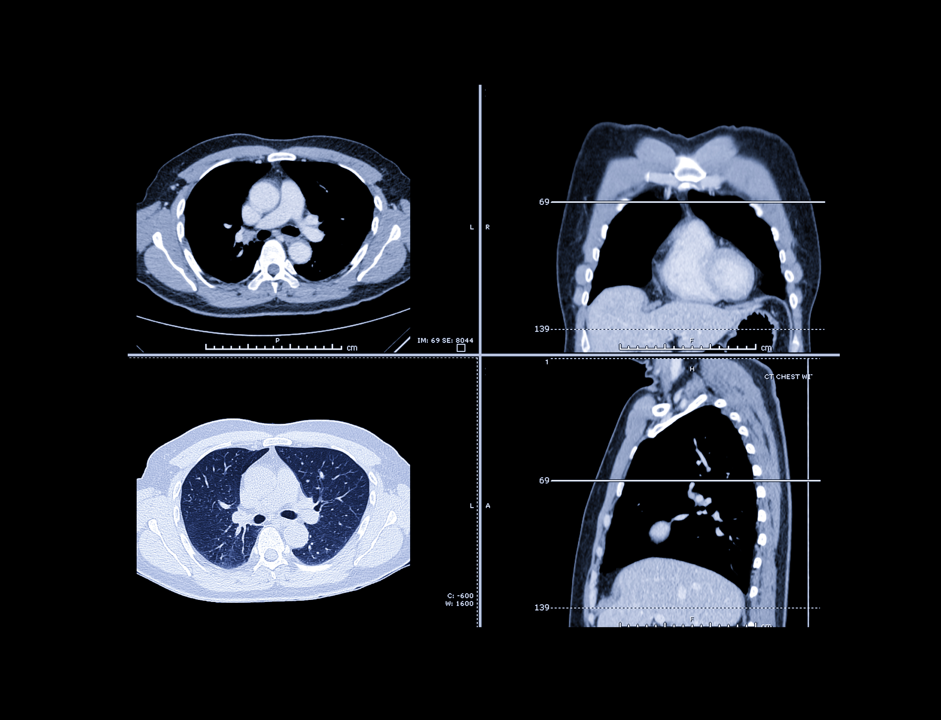 New Study Suggests Lung-Related Comorbidities Have No Impact on Lung Cancer Detection