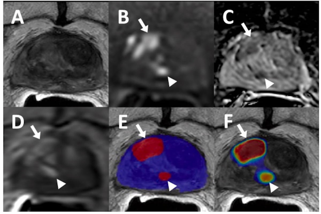 Can A Deep Learning Algorithm Enhance Detection of Prostate Cancer Recurrence with Biparametric MRI?