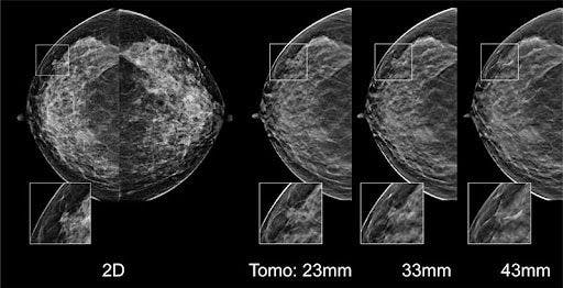 AI for Digital Breast Tomosynthesis Enhances Diagnostic Performance 