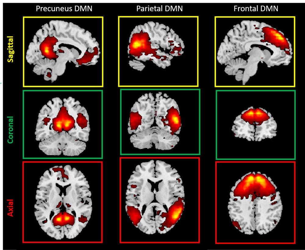 Brain Imaging Shows Damage to Youth Football Players