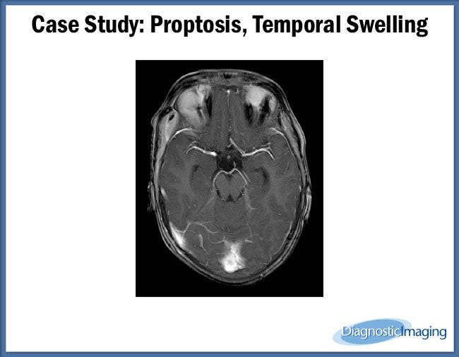 Proptosis, Temporal Swelling